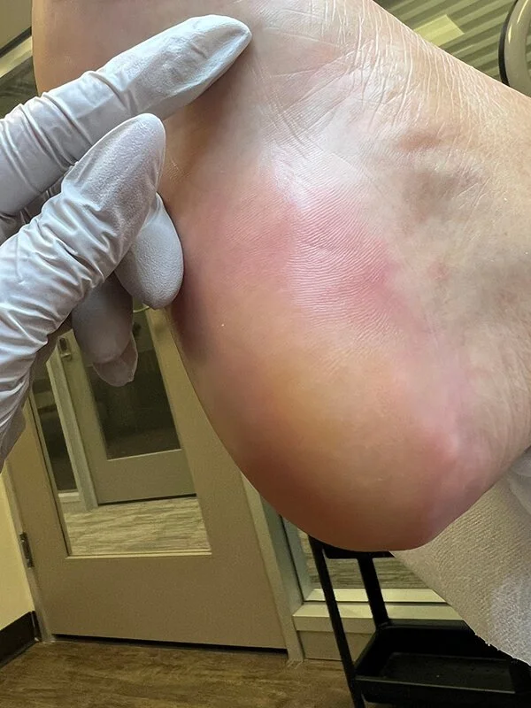 Smooth heel after professional Deep Foot Treatment