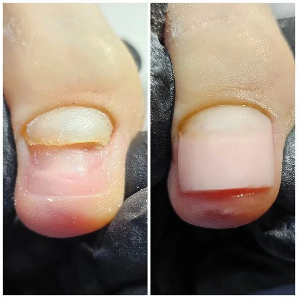 Toenail reconstruction result at Nail House USA