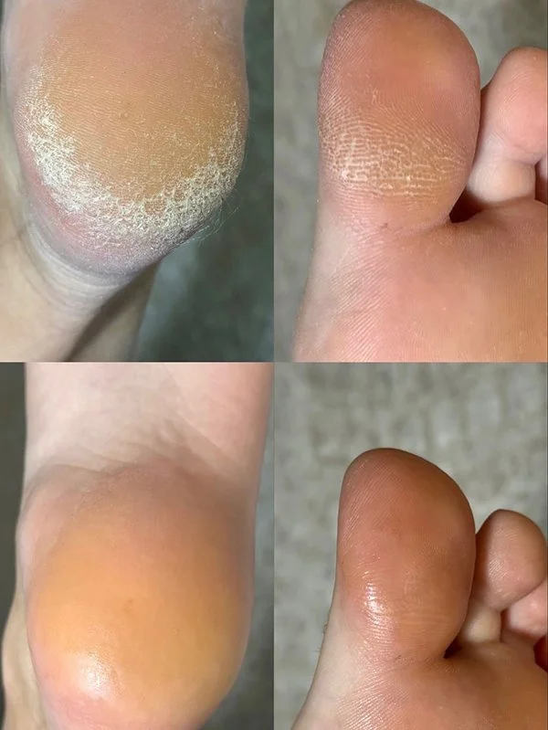 Before and after cosmetic care for dry skin and surface heel cracks during a pedicure