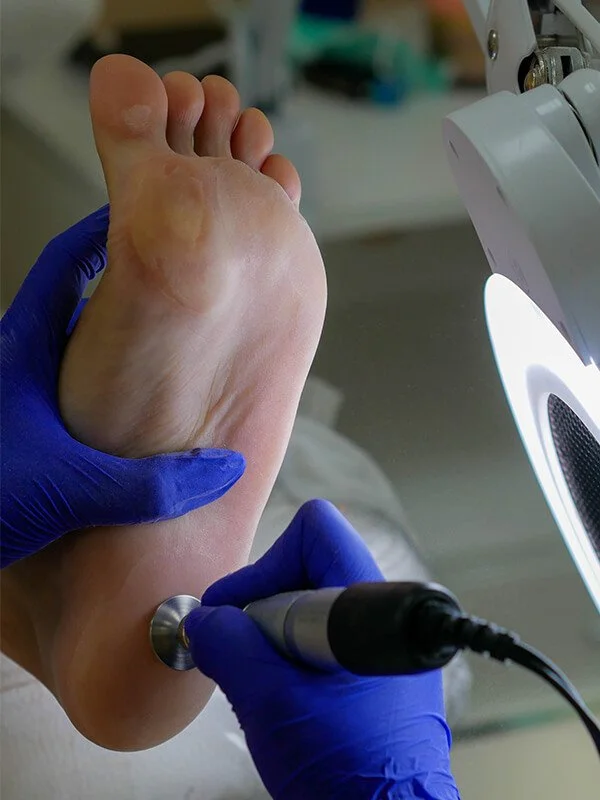 Deep Foot Treatment in progress with professional callus care
