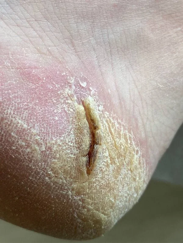 Dry rough heel before Deep Foot Treatment at Nail House USA