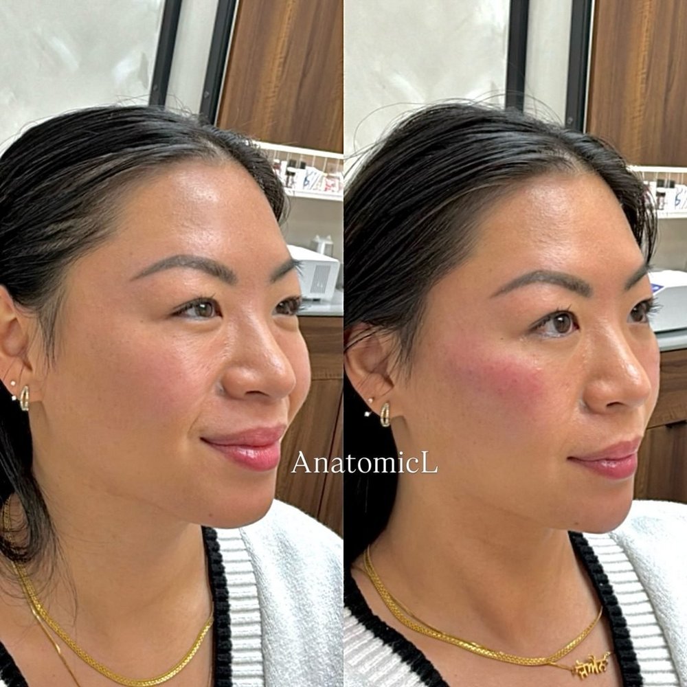 Facial balancing with filler and Botox, AnatomicL, Cherry Hill NJ – Facial Balancing For this patient, we focused on enhancing her features with profile definition and