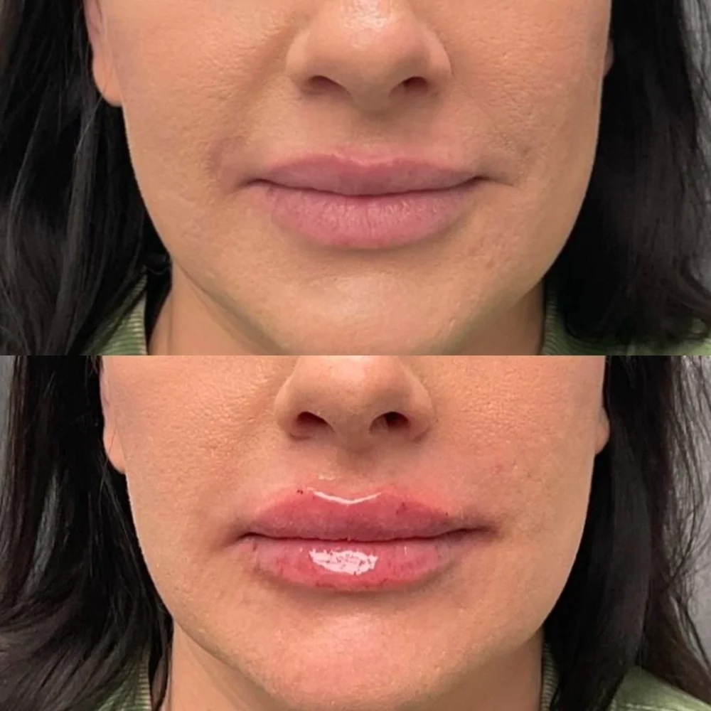 Lip and facial filler before and after, AnatomicL, Cherry Hill NJ – Read this before booking your lip filler Every lip is unique and your results should be too