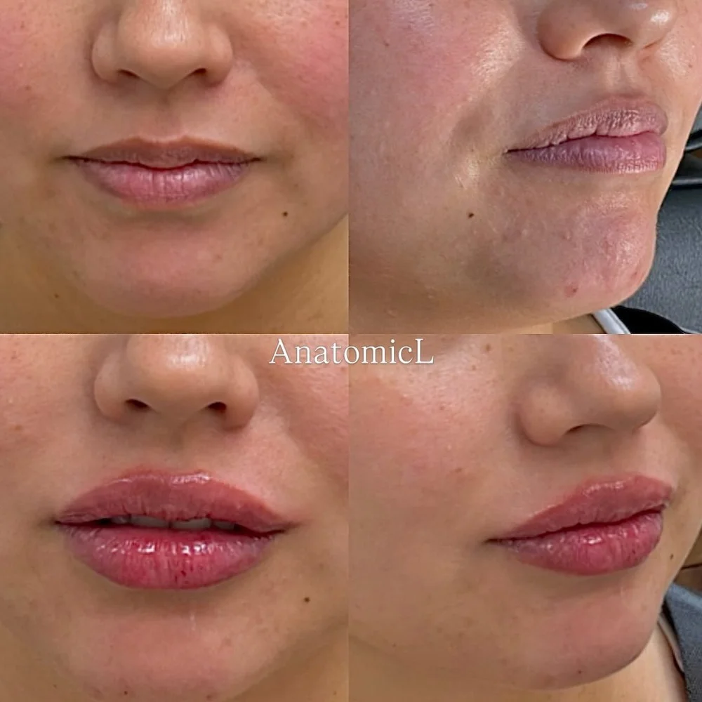 Lip and facial filler before and after, AnatomicL, Cherry Hill NJ – This is what Subtlety looks like when patients ask for Natural Lip Hydration These are immediate