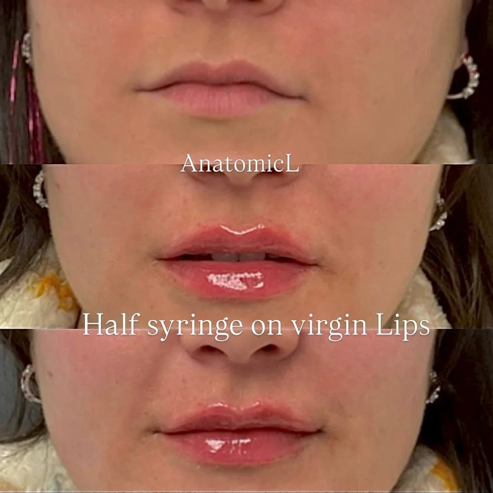 Lip and facial filler before and after, AnatomicL, Cherry Hill NJ – Perfect for anyone who wants to ease into lip filler and keep things looking like you just a little