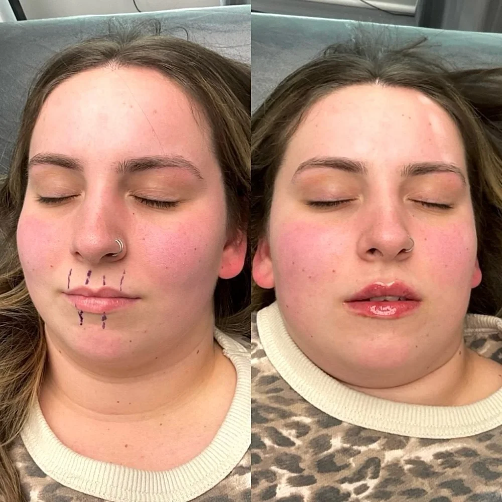 Lip and facial filler before and after, AnatomicL, Cherry Hill NJ – Not all lip fillers are the same.