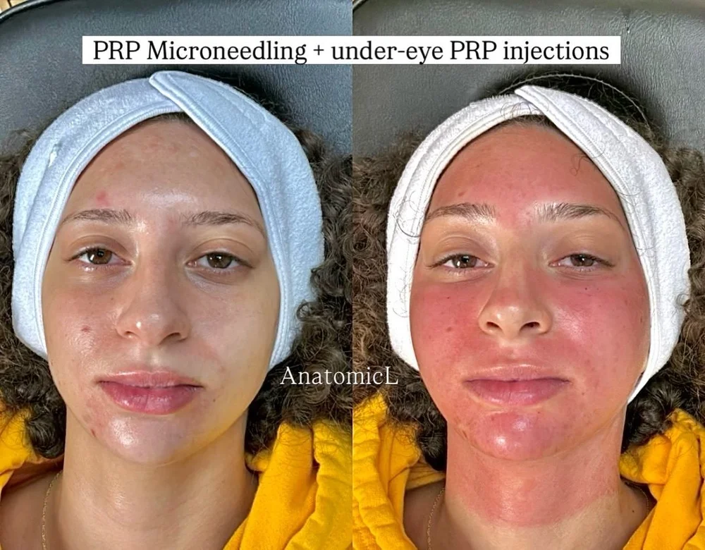 PRP and PRF before and after, AnatomicL, Cherry Hill NJ – This is what a beautiful, immediate post-treatment response looks like