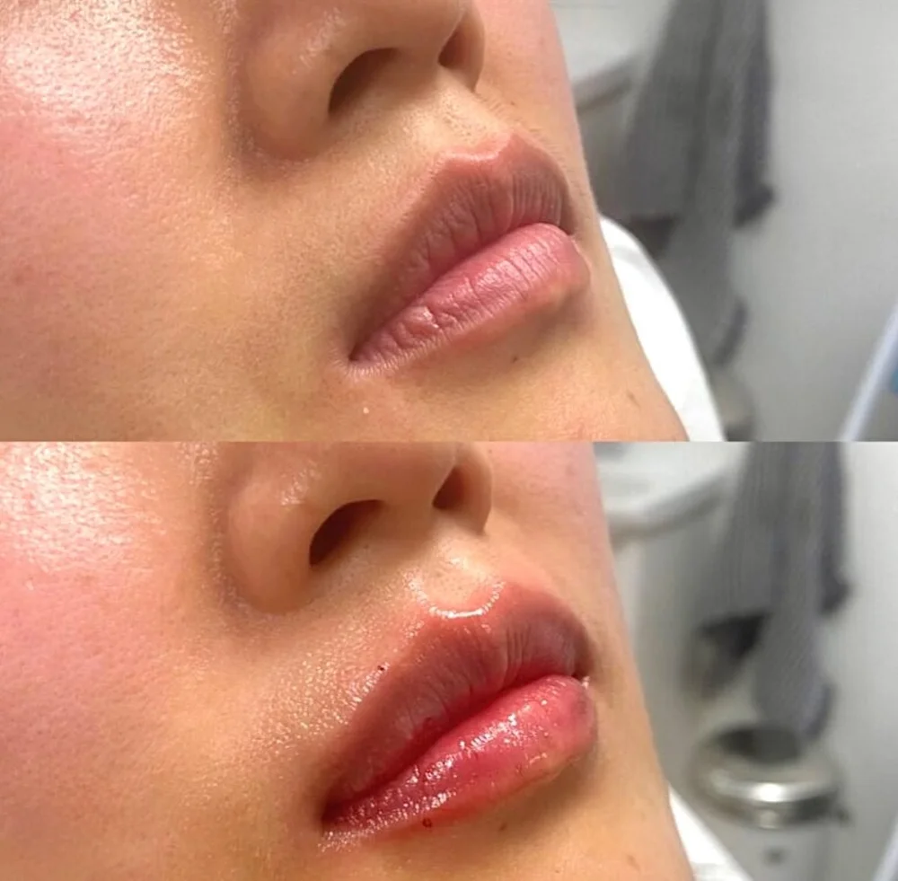 Lip and facial filler before and after, AnatomicL, Cherry Hill NJ – Soft volume. Clean borders. Zero overfill