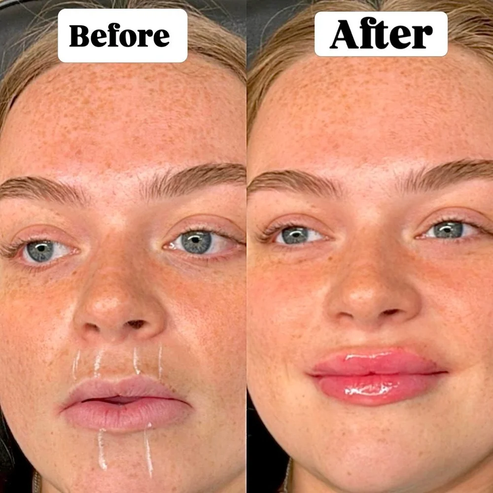 Lip and facial filler before and after, AnatomicL, Cherry Hill NJ – Just soft, pillowy, hydrated perfection. Drop a in the comments if you love this look