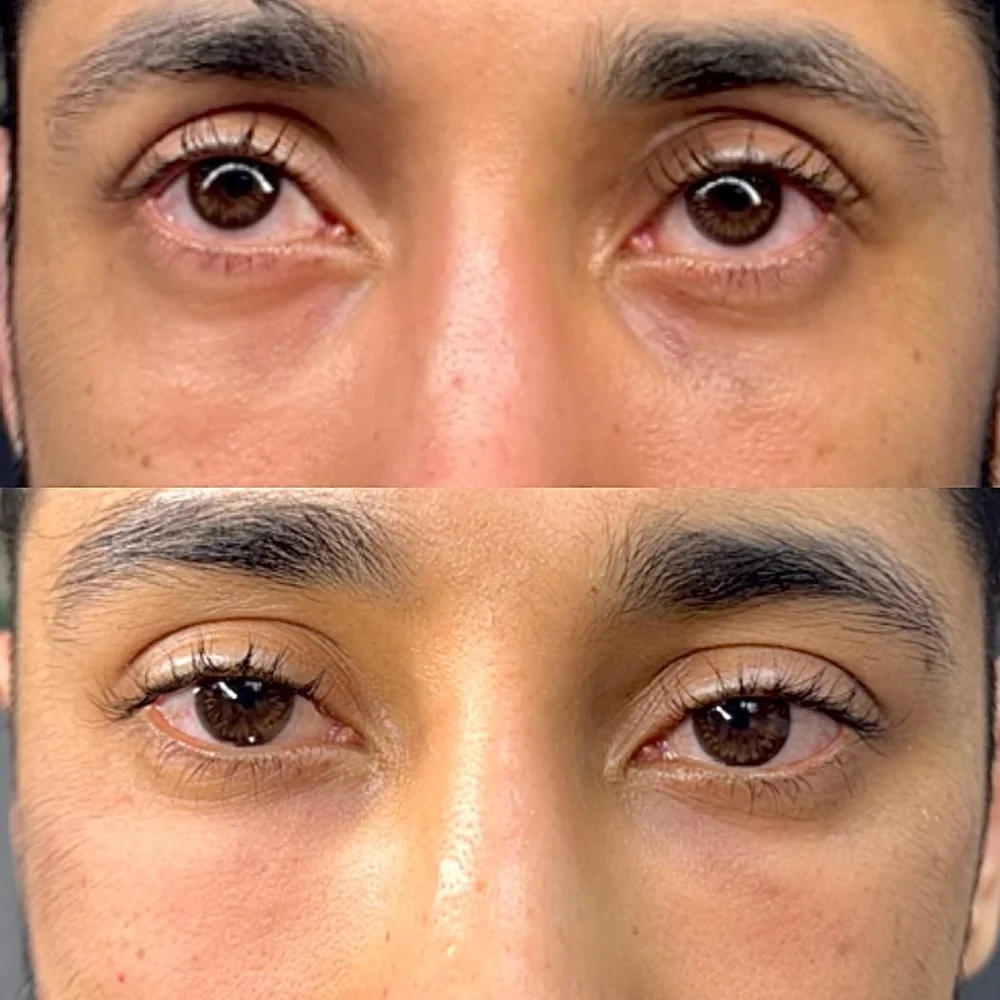 PRP and PRF before and after, AnatomicL, Cherry Hill NJ – Under-eye PRF: Session 2 results Natural refresh, improved texture