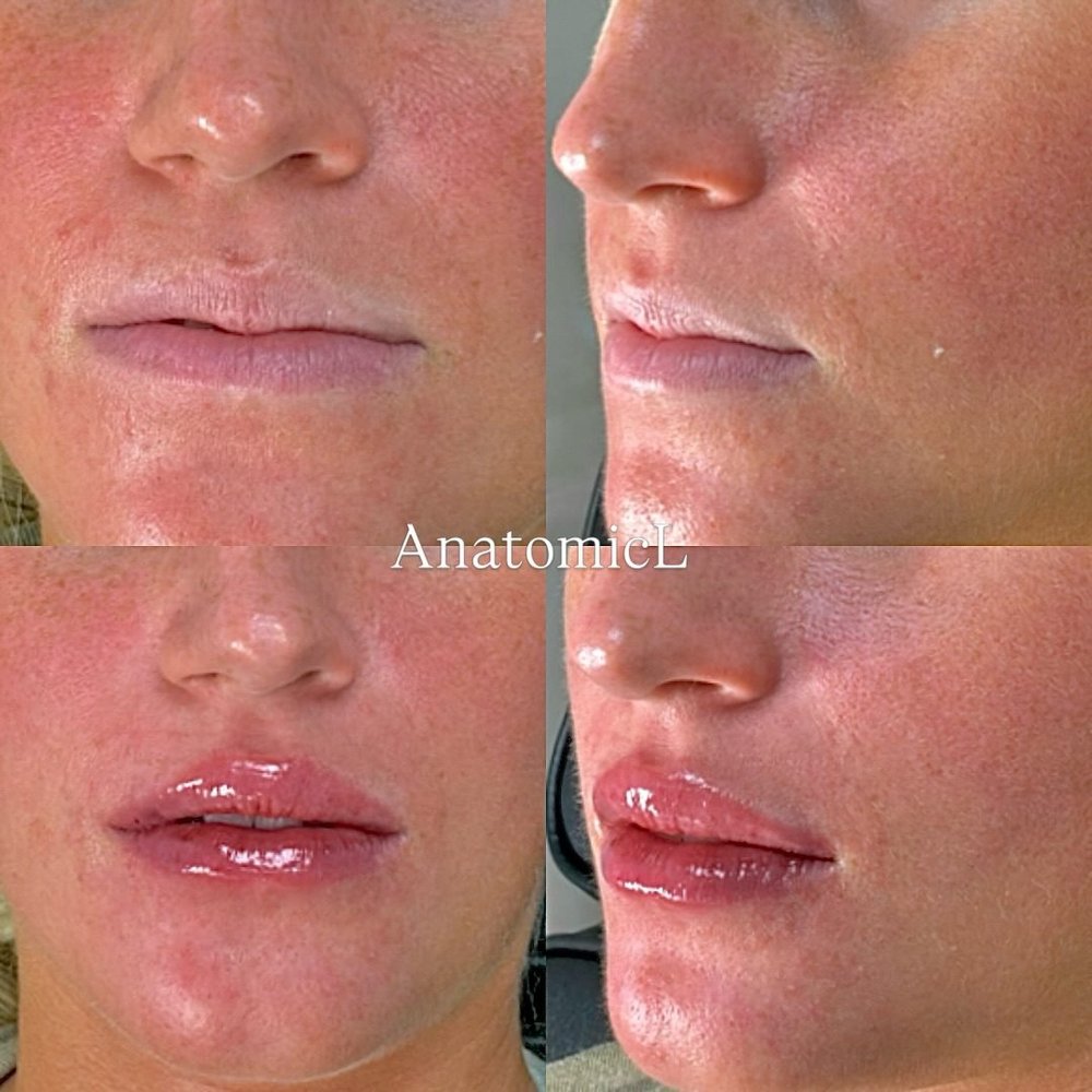 Lip and facial filler before and after, AnatomicL, Cherry Hill NJ – Hydration, shape, and perfect balance We love a natural lip!