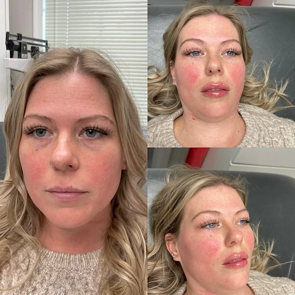 Lip and facial filler before and after, AnatomicL, Cherry Hill NJ – POV: filler for structure + microneedling for texture This combo never misses