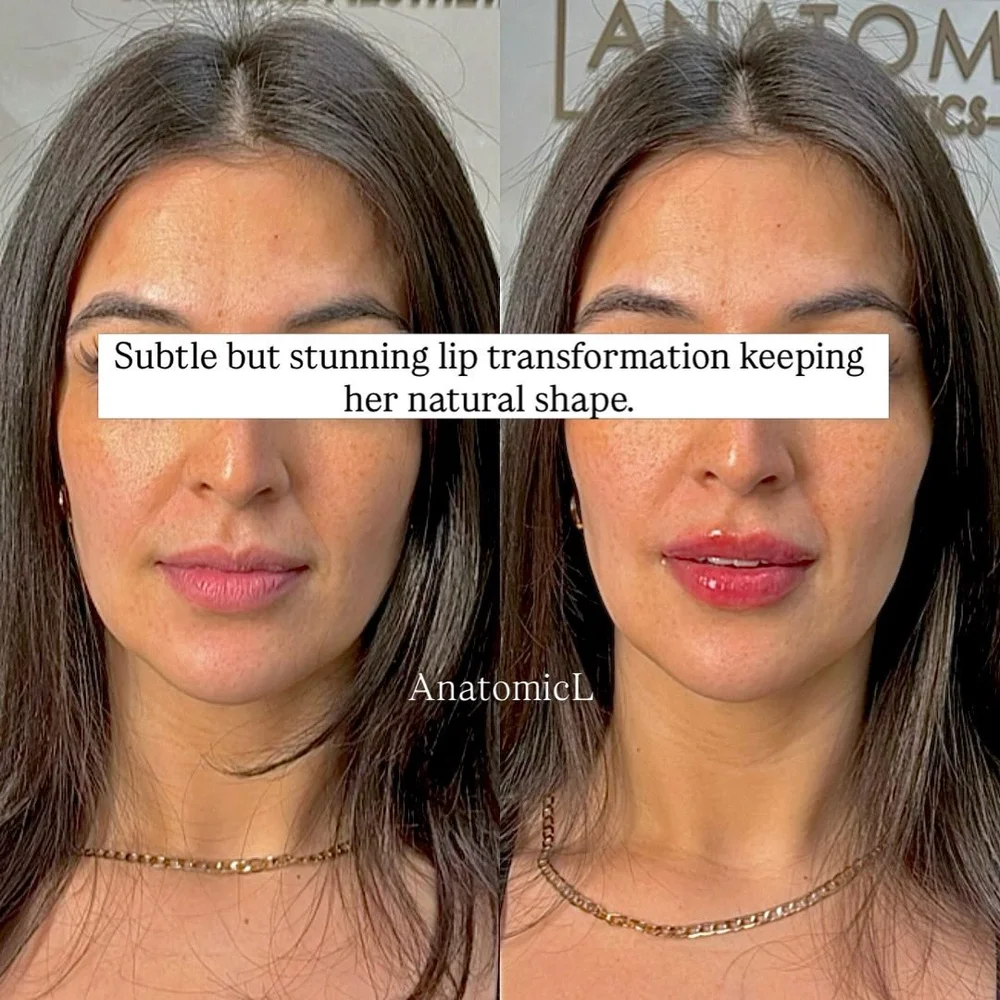 Lip and facial filler before and after, AnatomicL, Cherry Hill NJ – A beautiful lip enhancement shouldn t look like a trend