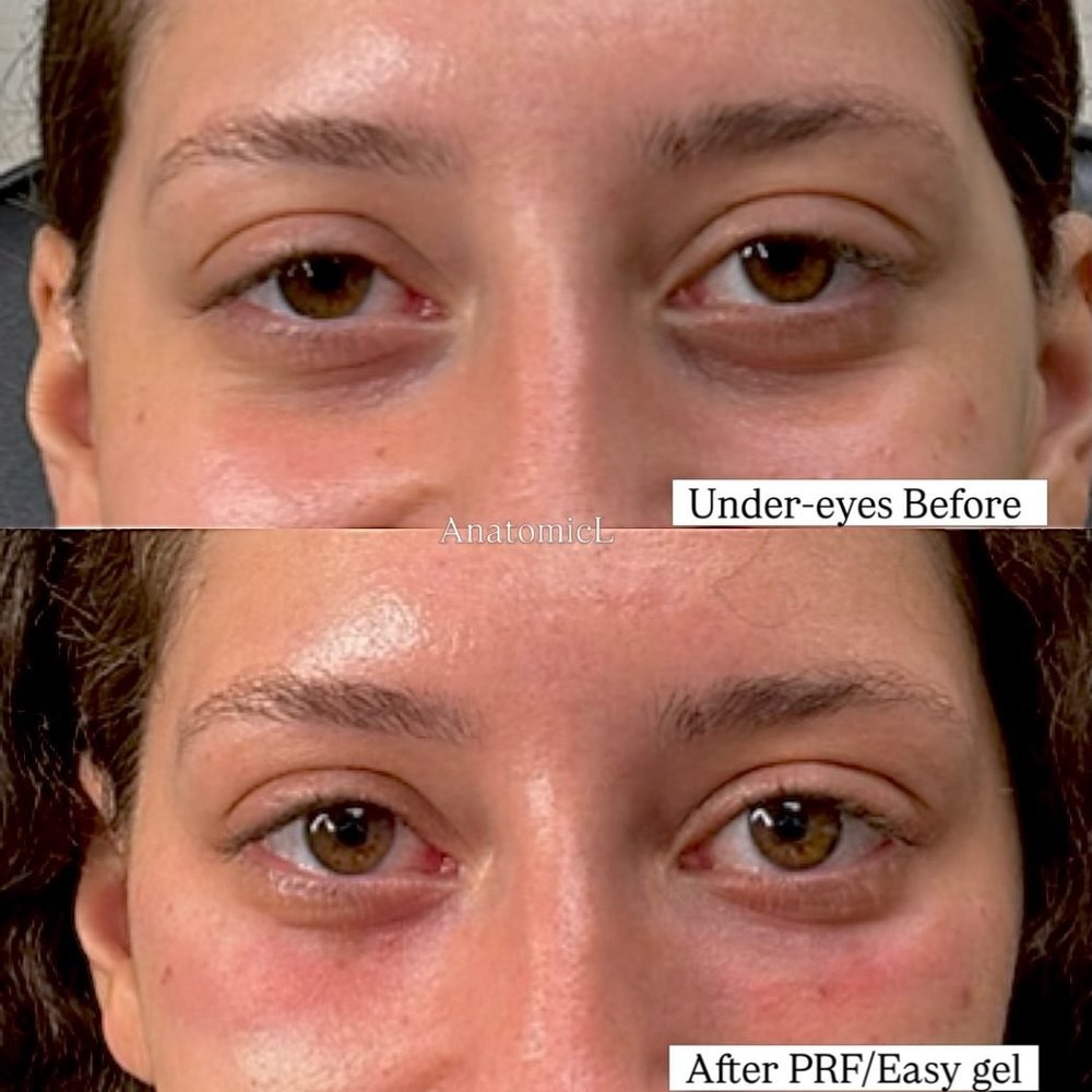 PRP and PRF before and after, AnatomicL, Cherry Hill NJ – Stop scrolling if you want filler results WITHOUT the filler!