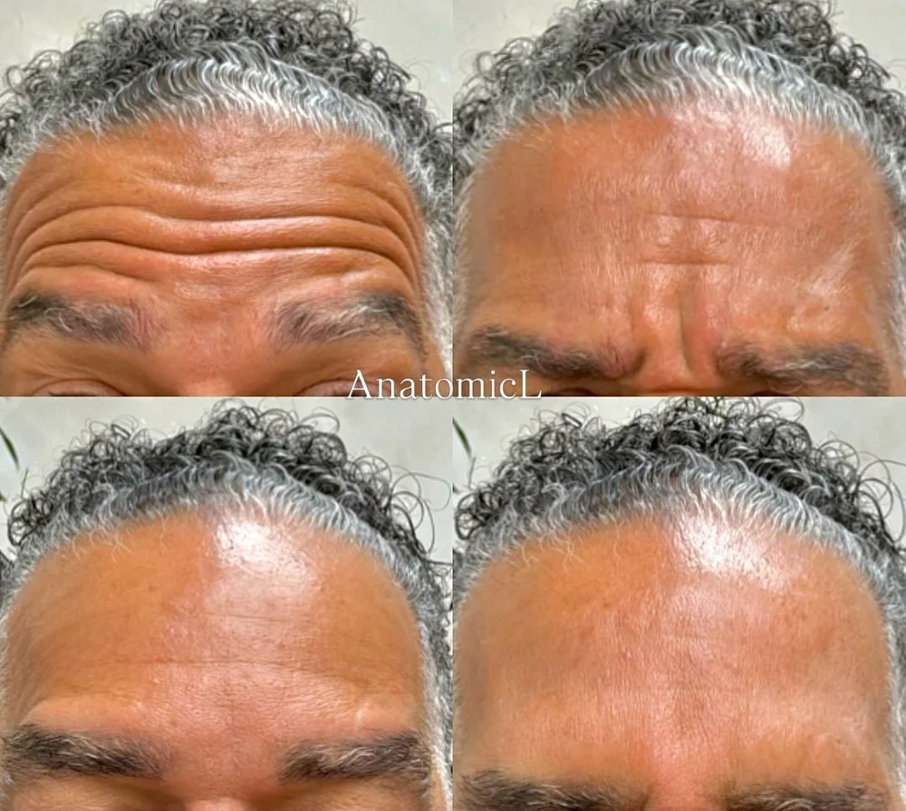 Botox before and after, AnatomicL, Cherry Hill NJ – Men have significantly greater muscle mass in their face