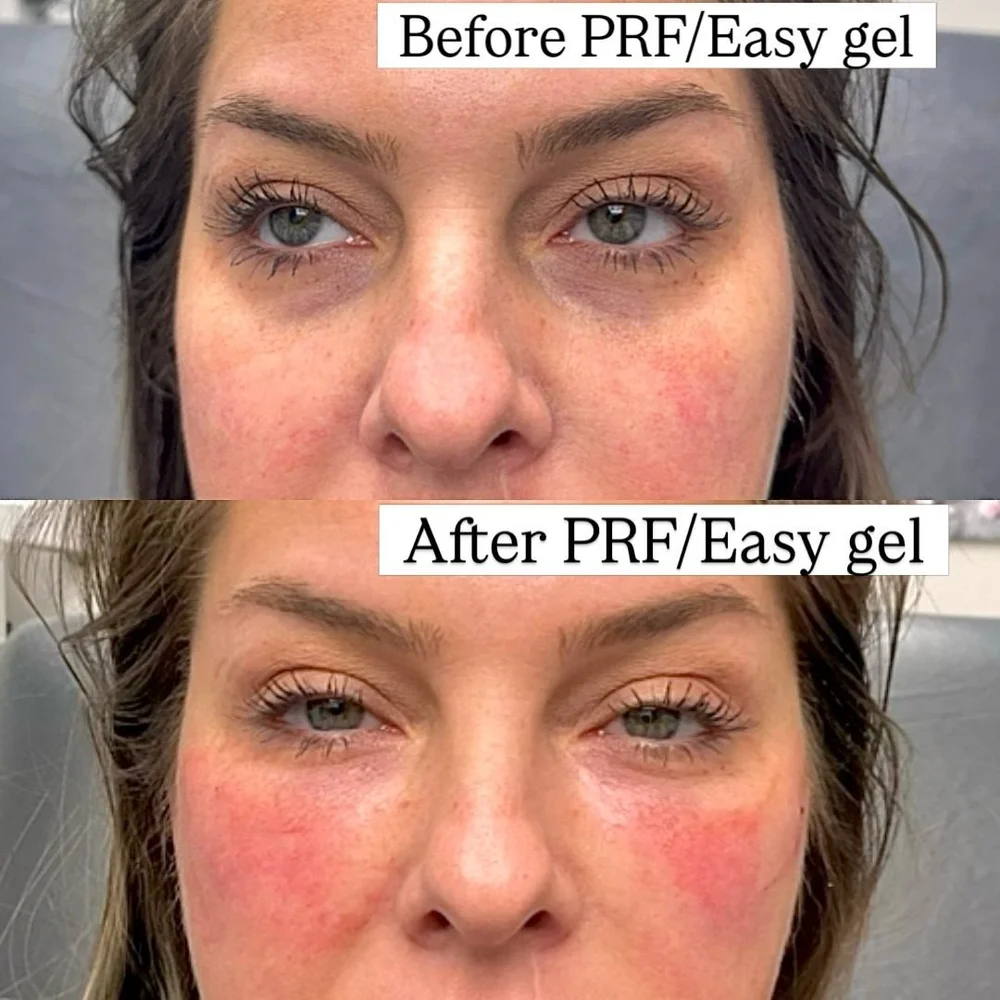 PRP and PRF before and after, AnatomicL, Cherry Hill NJ – Hesitant about under-eye fillers? Let s talk PRF