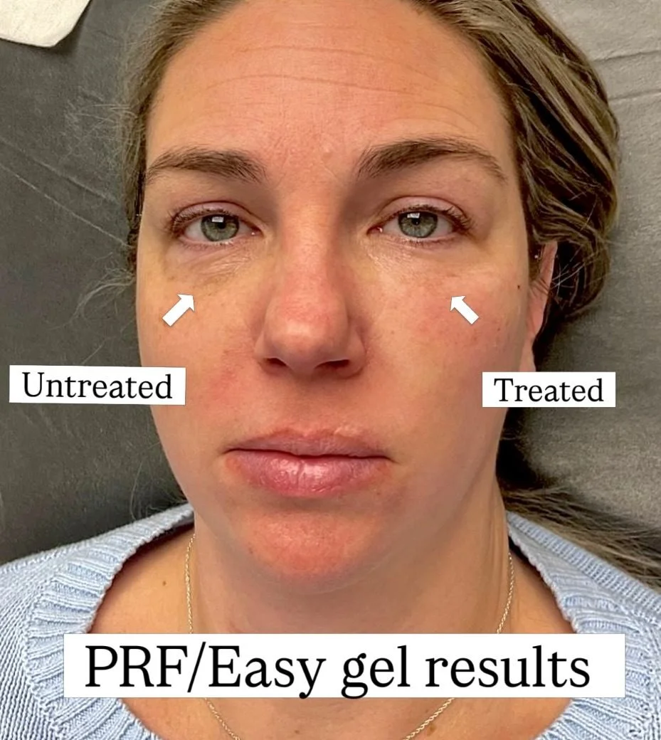 PRP and PRF before and after, AnatomicL, Cherry Hill NJ – Before & After: Under Eye PRF + Look at