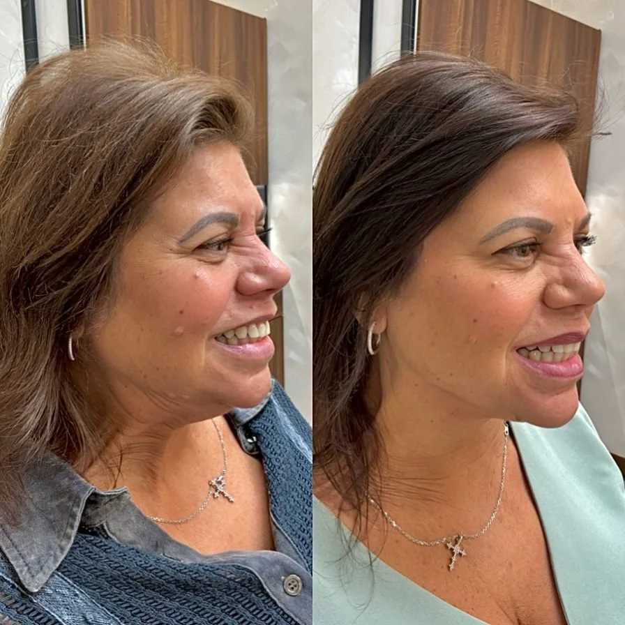 Botox before and after, AnatomicL, Cherry Hill NJ – How to fix jowls and lower face sagging!