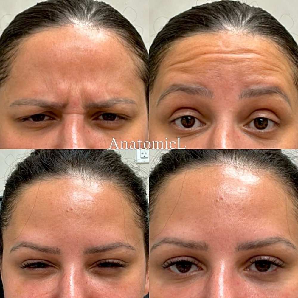 Botox before and after, AnatomicL, Cherry Hill NJ – Another example of a customized treatment for this patient