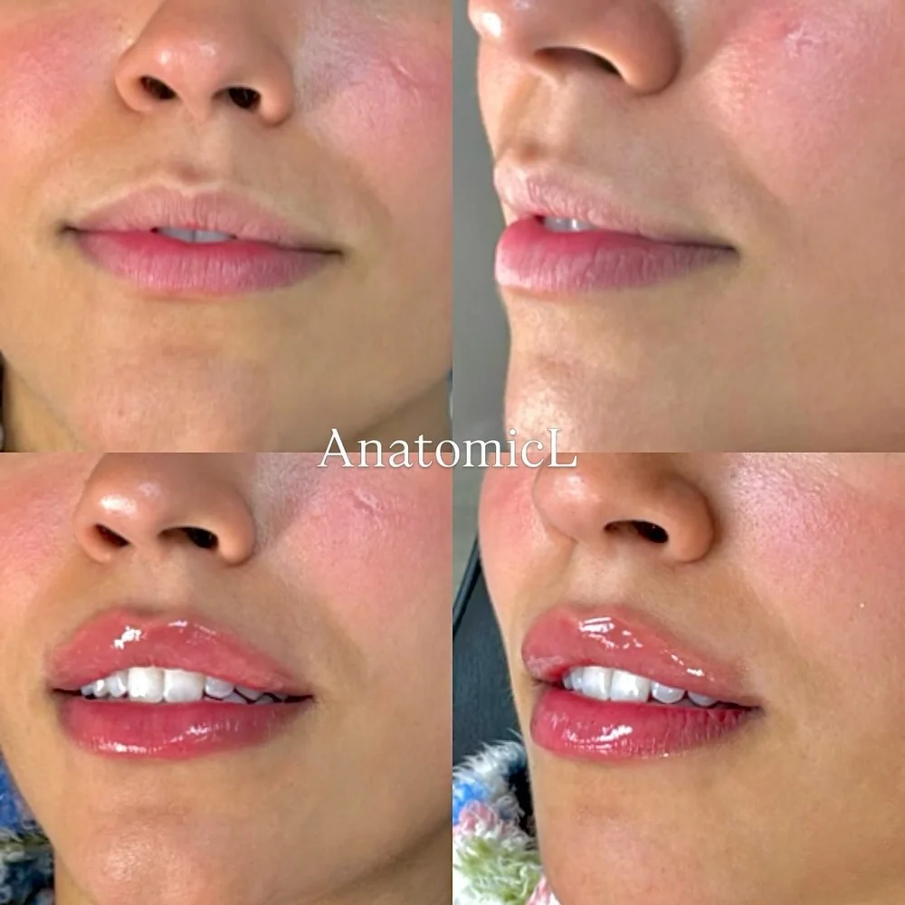 Lip and facial filler before and after, AnatomicL, Cherry Hill NJ – 0.5mL- Less than you think, More than Enough If you ve been scared of lip filler looking too much, this