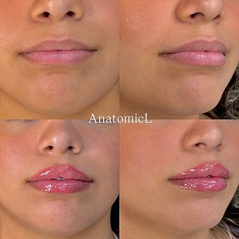 Lip and facial filler before and after, AnatomicL, Cherry Hill NJ – Many people feel hesitant about lip filler because of what they see online