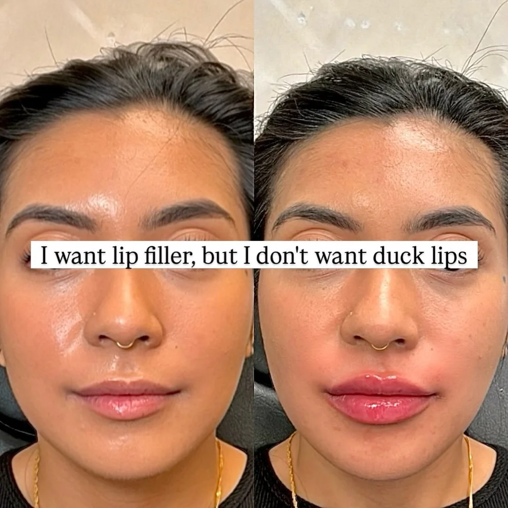 Lip and facial filler before and after, AnatomicL, Cherry Hill NJ – I hear this in the clinic every single day!