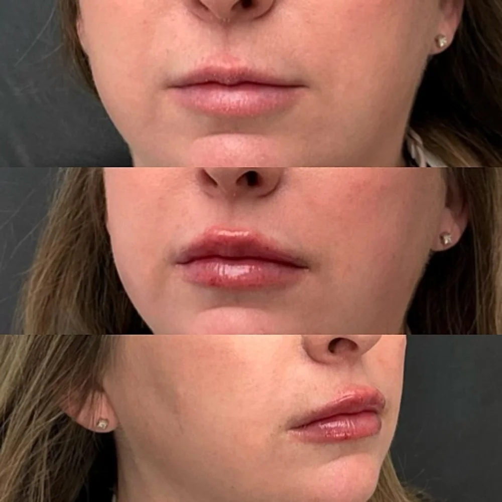Lip and facial filler before and after, AnatomicL, Cherry Hill NJ – A little plump goes a long way