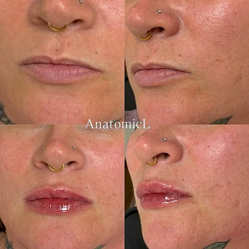 Lip and facial filler before and after, AnatomicL, Cherry Hill NJ – Sometimes, subtle enhancements make the biggest difference