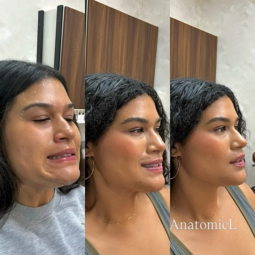Botox before and after, AnatomicL, Cherry Hill NJ – Giving a little extra love to the lower face is one of our favorite ways to help you feel refreshed