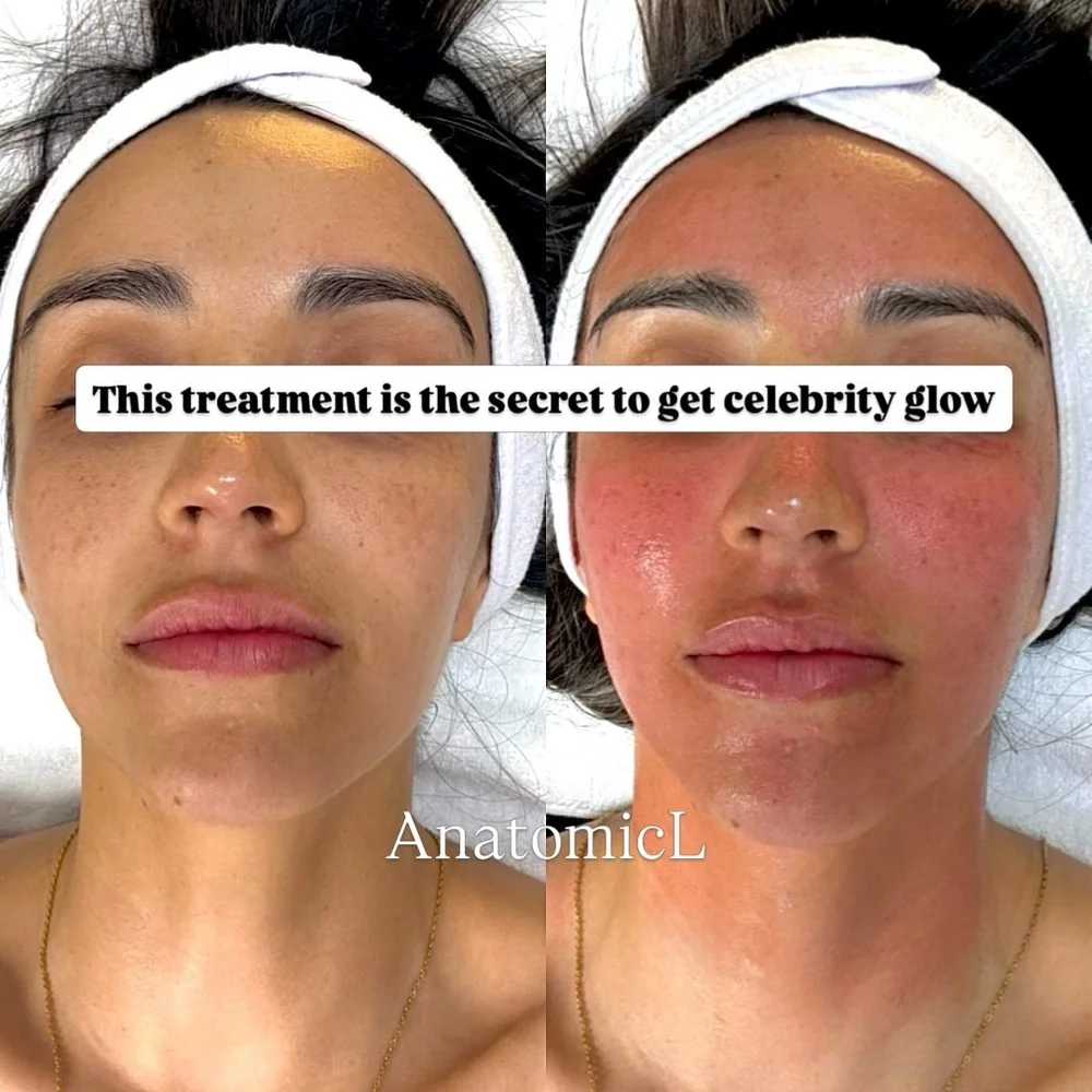 PRP and PRF before and after, AnatomicL, Cherry Hill NJ – This is the ultimate glow up for that glass like skin