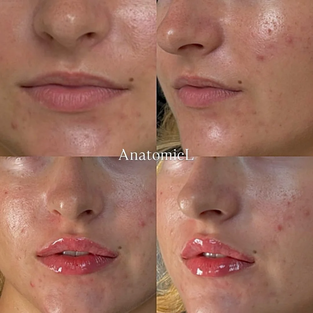 Lip and facial filler before and after, AnatomicL, Cherry Hill NJ – Taking the leap to get lip filler for the first time can feel a little nerve-wracking!