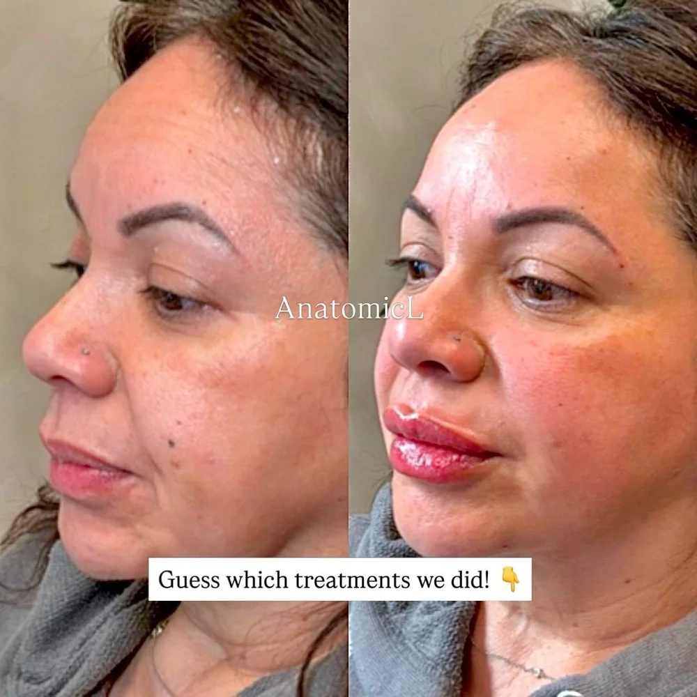 Skin rejuvenation before and after, AnatomicL, Cherry Hill NJ – Turning back the clock doesn t mean looking like a different person