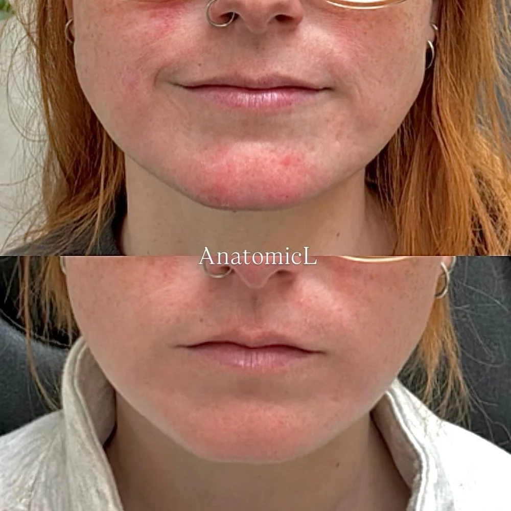 Botox before and after, AnatomicL, Cherry Hill NJ – Massetertox Over time, constant clenching and grinding doesn t just cause TMJ pain and tension