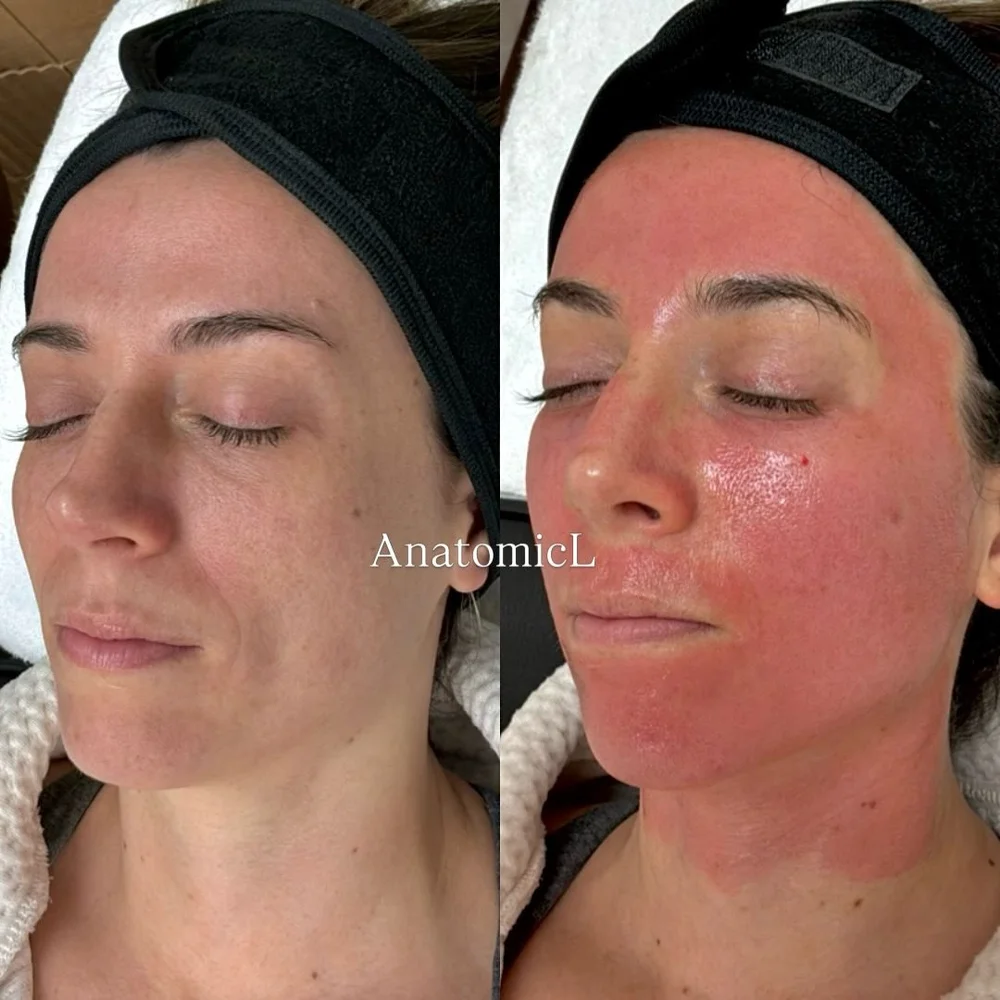 Skin rejuvenation before and after, AnatomicL, Cherry Hill NJ – True facial balancing doesn t ALWAYS start with a syringe SOMETIMES it starts with your skin!