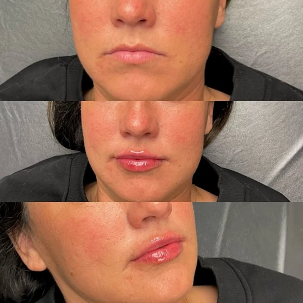Lip and facial filler before and after, AnatomicL, Cherry Hill NJ – Read this before booking lip filler Shape > volume Less is more Technique matters