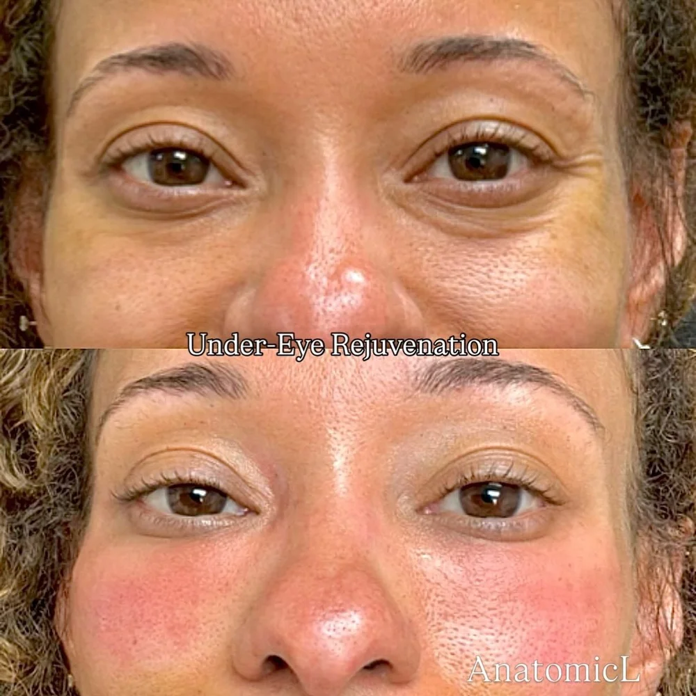 PRP and PRF before and after, AnatomicL, Cherry Hill NJ – Let s talk about the magic of using your body s own natural liquid gold to refresh and brighten the