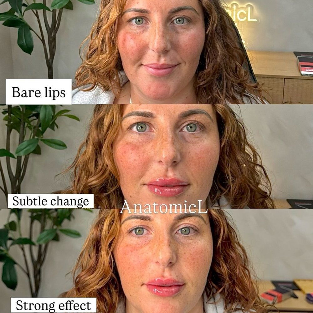 Lip and facial filler before and after, AnatomicL, Cherry Hill NJ – We love a good transformation!