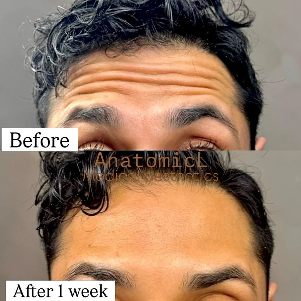 Botox before and after, AnatomicL, Cherry Hill NJ – The first place aging usually shows? Your forehead and the 11s between the brows