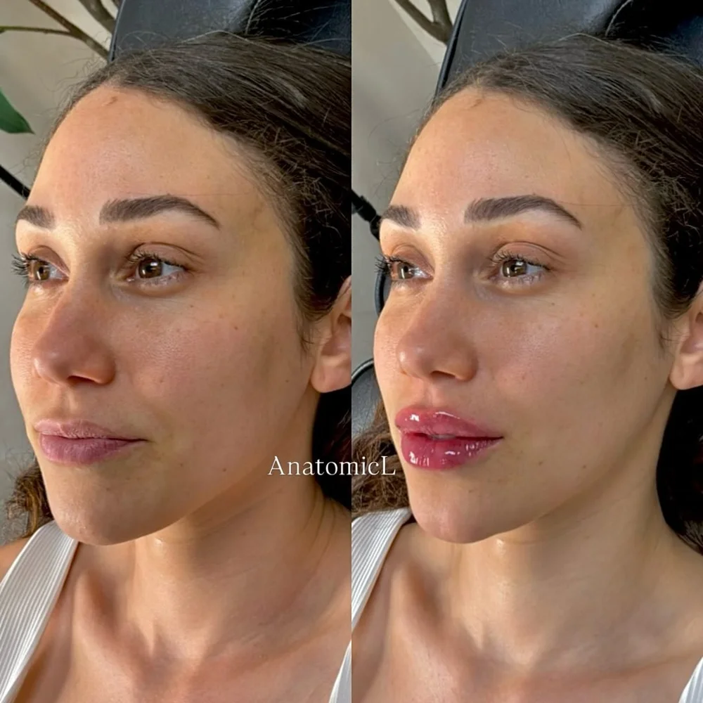 Lip and facial filler before and after, AnatomicL, Cherry Hill NJ – A little refresh Just enough to bring everything into balance and compliment her features