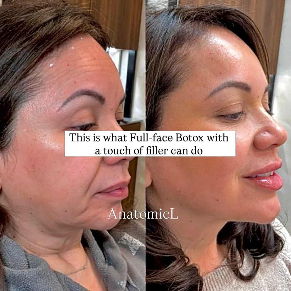 Facial balancing with filler and Botox, AnatomicL, Cherry Hill NJ – Facial balancing is the reason people will ask if you went on vacation or got great sleep
