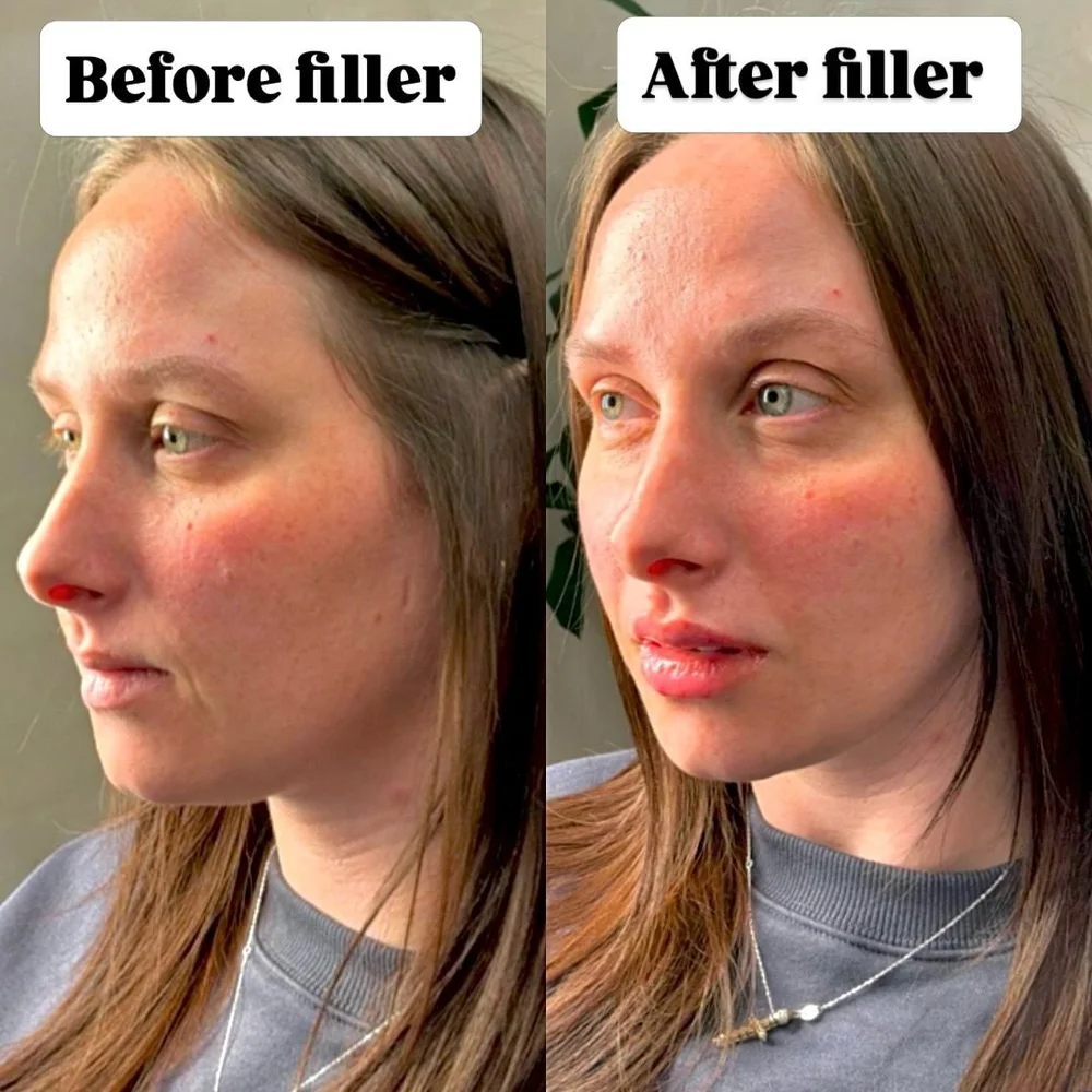 Lip and facial filler before and after, AnatomicL, Cherry Hill NJ – She was already naturally beautiful we just enhanced what was already there Subtle lip filler to elevate