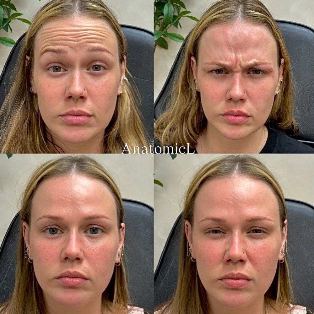 Botox before and after, AnatomicL, Cherry Hill NJ – Full Face tox refresh Something to refresh your face without looking overfilled