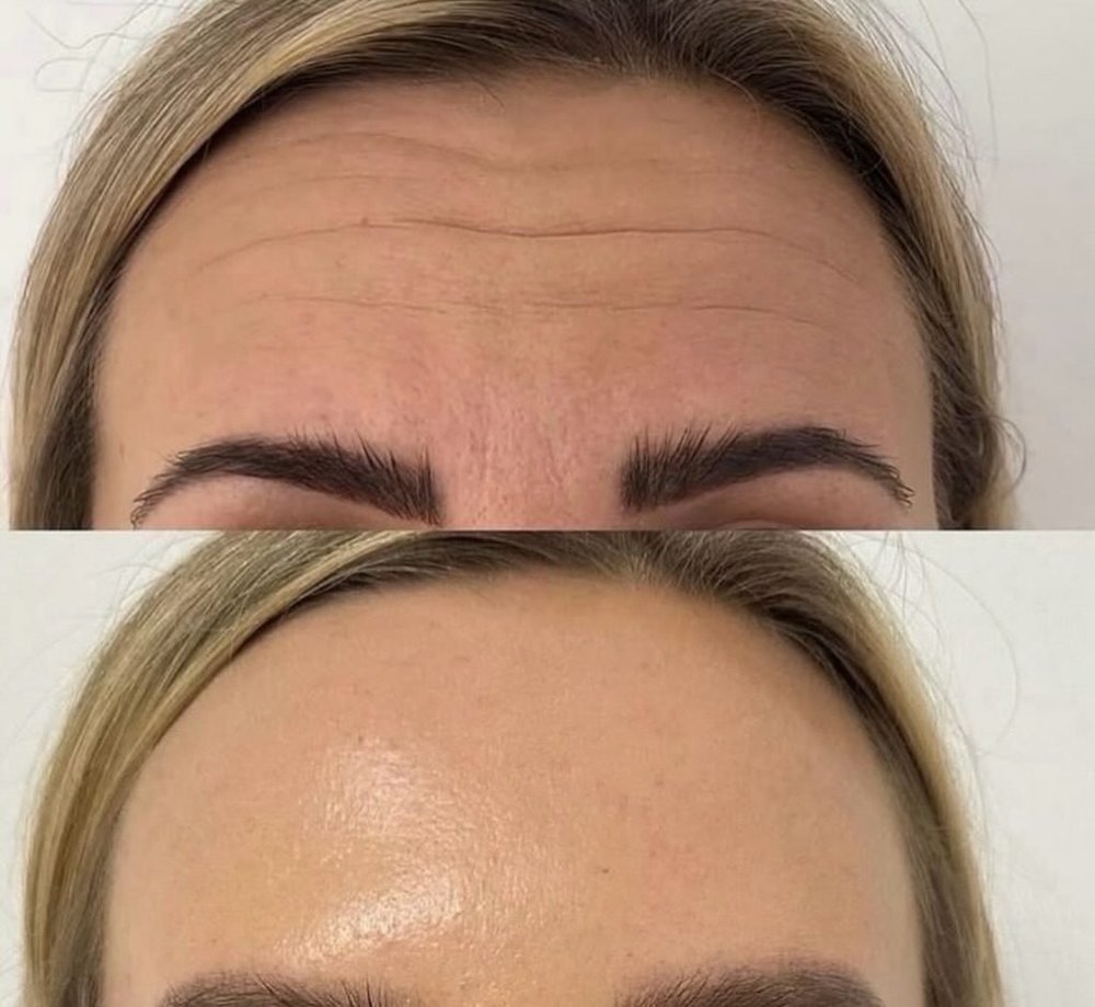 Botox before and after, AnatomicL, Cherry Hill NJ – Botox days are the best days