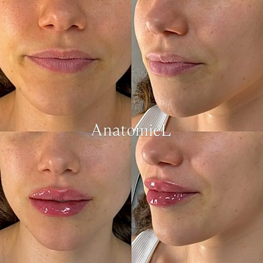 Lip and facial filler before and after, AnatomicL, Cherry Hill NJ – The lips you have, just better. Fuller. Softer. Still completely you