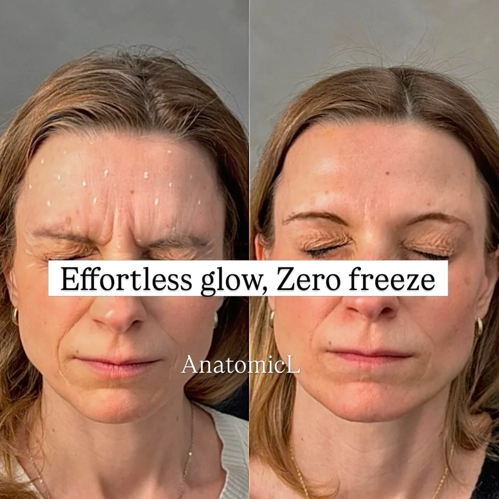 Botox before and after, AnatomicL, Cherry Hill NJ – I have a lot of feelings, I just don t want my forehead to show them