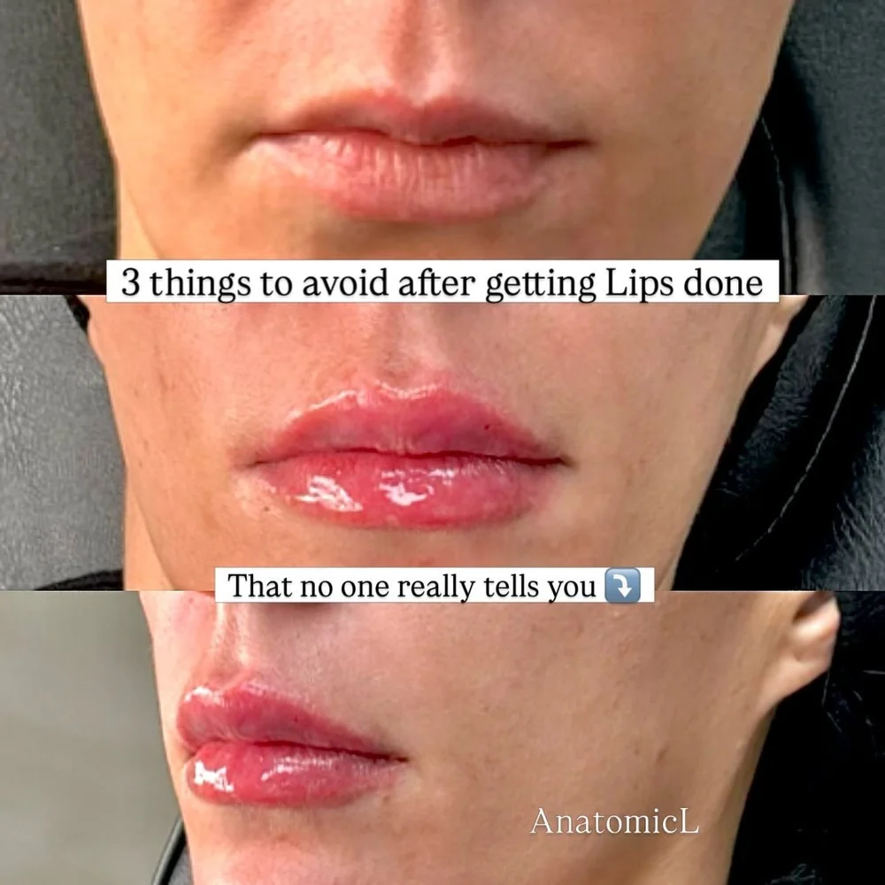 Lip and facial filler before and after, AnatomicL, Cherry Hill NJ – Avoid Exercise/Excessive heat exposure -increases heart rate and body temperature