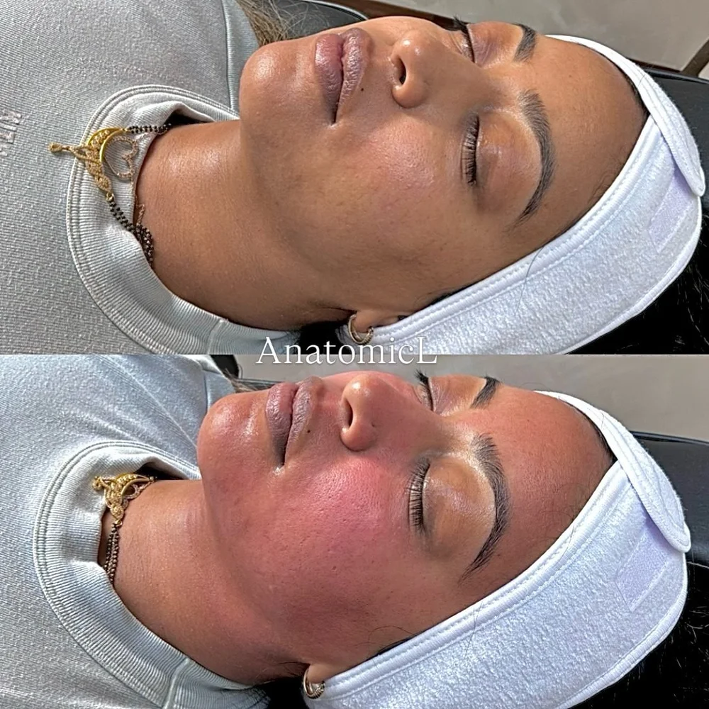 PRP and PRF before and after, AnatomicL, Cherry Hill NJ – Will my skin be red? Yes! And it means the treatment is doing exactly what it should