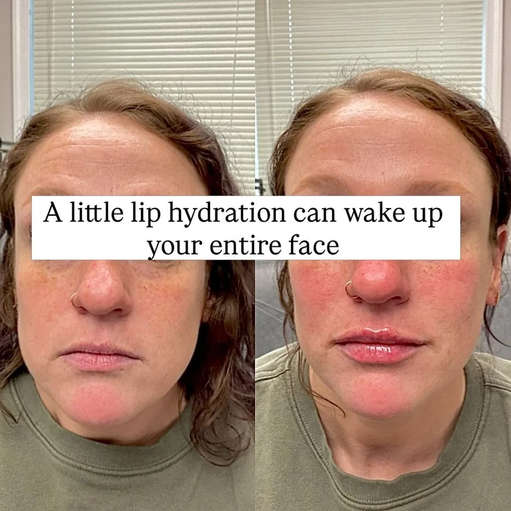 Lip and facial filler before and after, AnatomicL, Cherry Hill NJ – Sometimes all you need is a little refresh