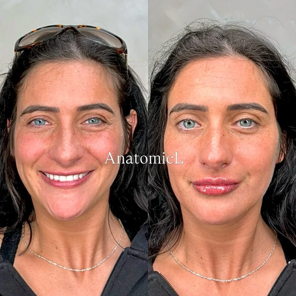 Lip and facial filler before and after, AnatomicL, Cherry Hill NJ – Adding a touch of HA gel to the lips does so much more than just plump
