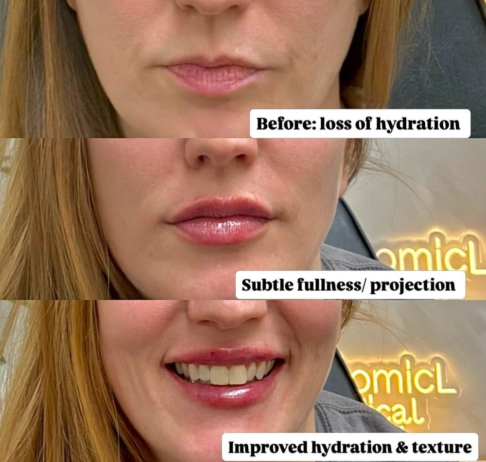 Lip and facial filler before and after, AnatomicL, Cherry Hill NJ – Sometimes it s not about adding volume or using more filler